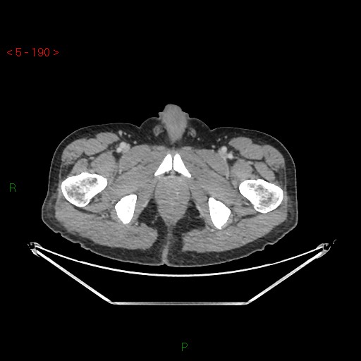 File:Closed loop obstruction and appendicular stump mucocele (Radiopaedia 54014-61158 A 85).jpg