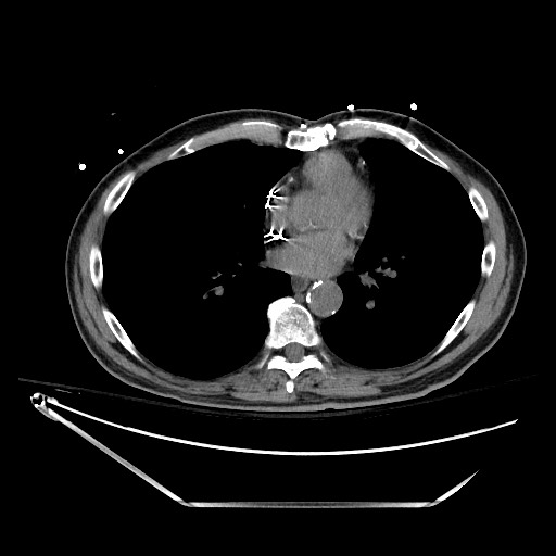 File:Closed loop obstruction due to adhesive band, resulting in small bowel ischemia and resection (Radiopaedia 83835-99023 Axial non-contrast 2).jpg