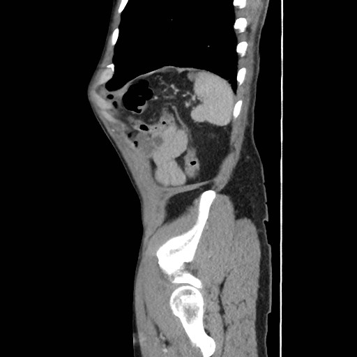 Closed loop small bowel obstruction (Radiopaedia 59227-66554 C 56).jpg