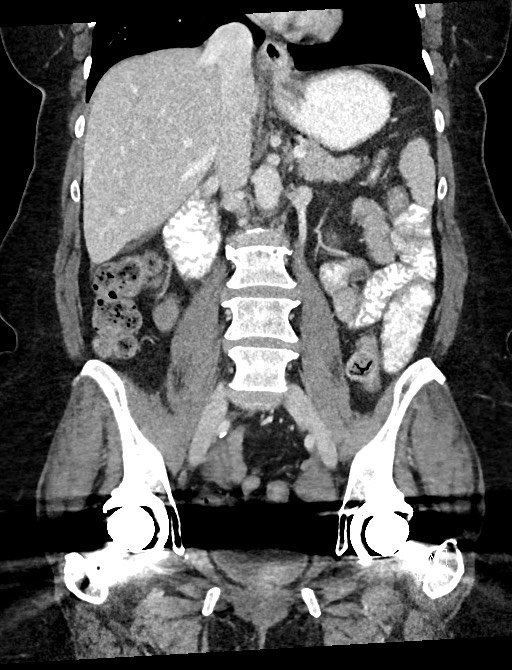 Closed loop small bowel obstruction - adhesions (Radiopaedia 59078-66369 B 68).jpg