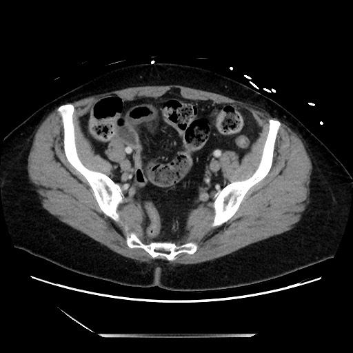 Closed loop small bowel obstruction due to adhesive bands - early and late images (Radiopaedia 83830-99014 A 120).jpg