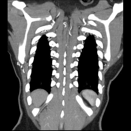 Coarctation of the aorta (Radiopaedia 67609-77010 B 10).jpg