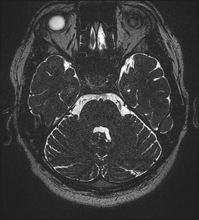 Cochlear incomplete partition type III associated with hypothalamic hamartoma (Radiopaedia 88756-105498 Axial T2 103).jpg