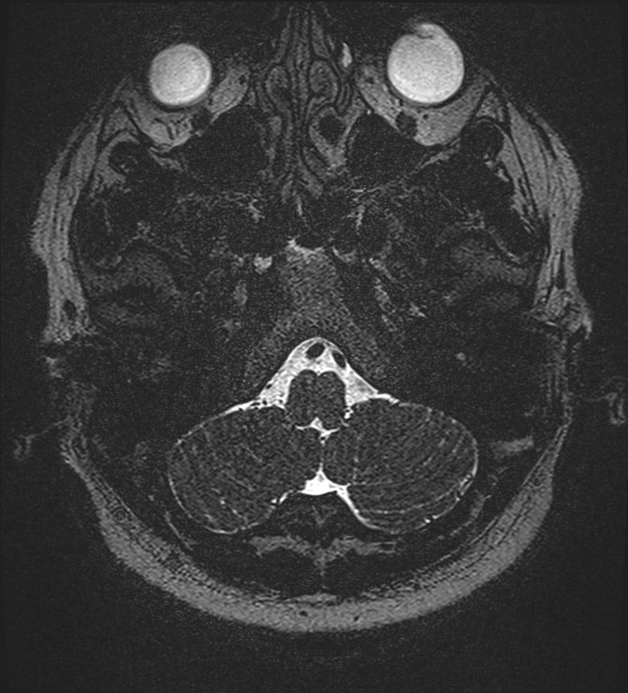 Cochlear incomplete partition type III associated with hypothalamic hamartoma (Radiopaedia 88756-105498 Axial T2 32).jpg
