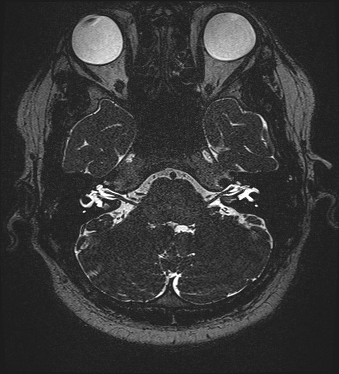 Cochlear incomplete partition type III associated with hypothalamic hamartoma (Radiopaedia 88756-105498 Axial T2 69).jpg