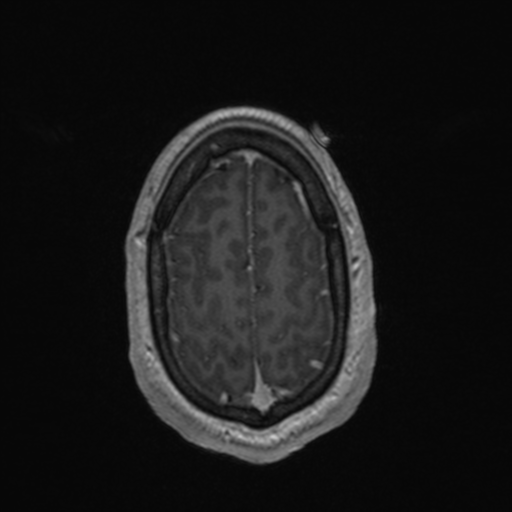 Colloid cyst (Radiopaedia 44510-48181 Axial T1 C+ 156).png