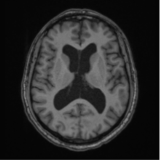 File:Colloid cyst of the third ventricle (Radiopaedia 86571-102662 Axial T1 43).png