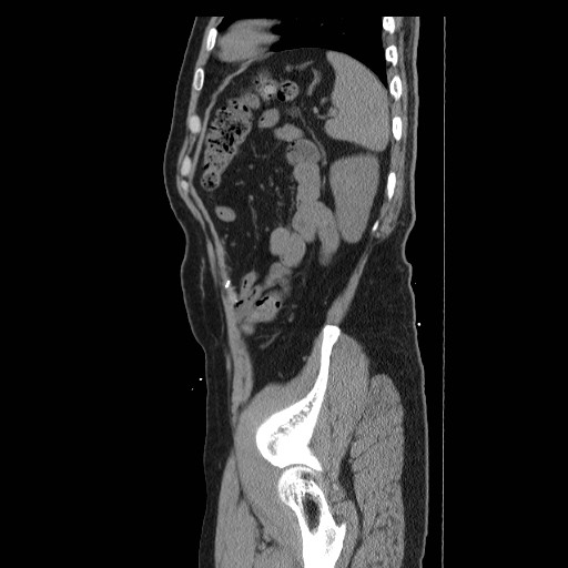 File:Colocutaneous fistula in Crohn's disease (Radiopaedia 29586-30093 C 53).jpg