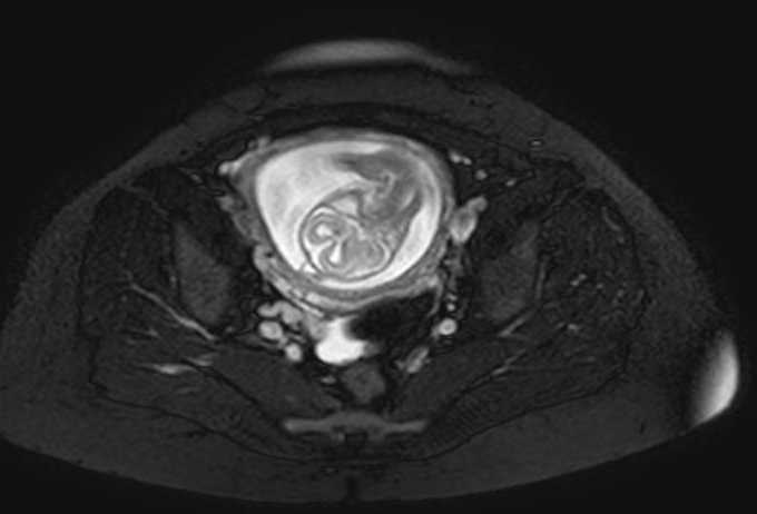 Colon adenocarcinoma with Krukenberg tumors, advanced pregnancy (Radiopaedia 67279-76645 Axial T2 SPAIR 14).jpg