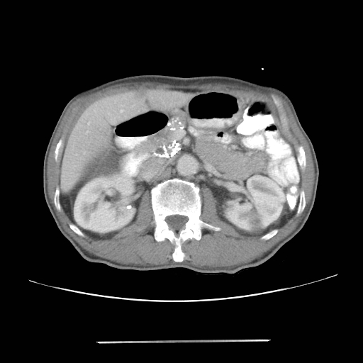 Colon cancer with calcified liver metastasis (Radiopaedia 74423-85307 A 28).jpg