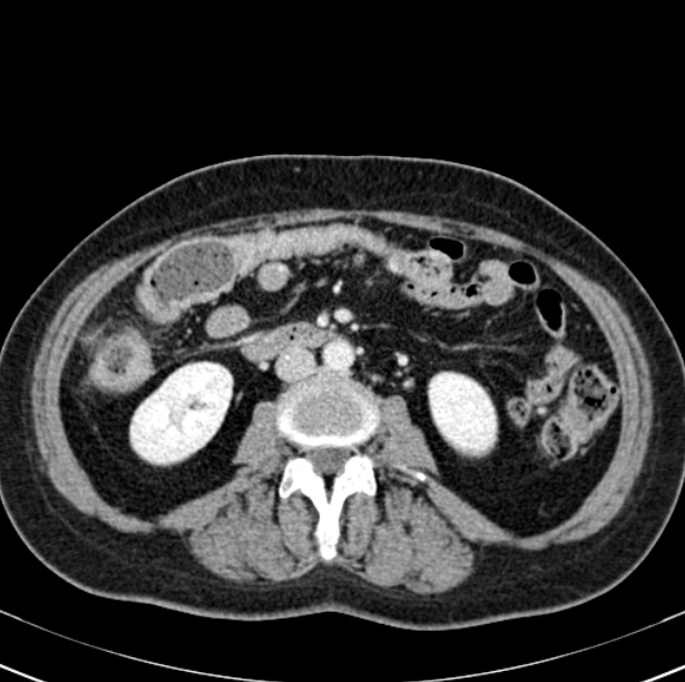 Colon carcinoma with hepatic metastases (Radiopaedia 29477-29961 A 57).jpg