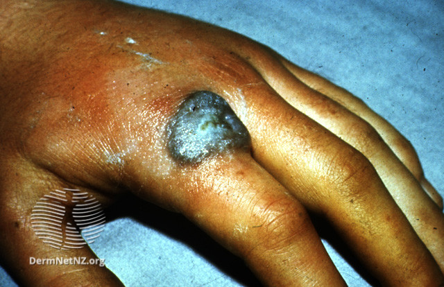 File:Cutaneous tuberculosis (DermNet NZ bacterial-warty-tb).jpg