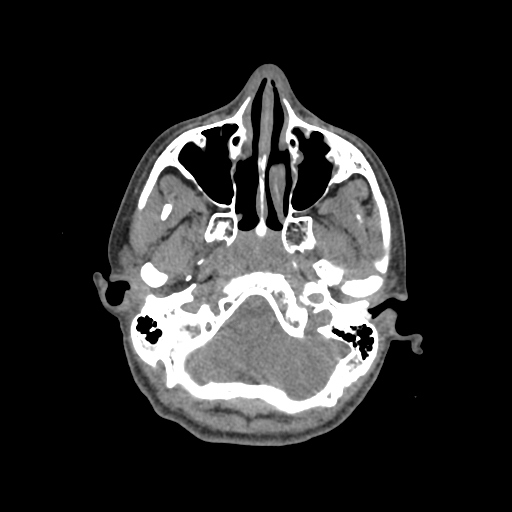 Nasal pyogenic granuloma (lobular capillary hemangioma) (Radiopaedia 85536-101244 Axial non-contrast 62).jpg