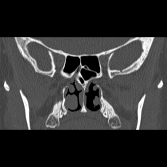 Nasal septal perforation (Radiopaedia 25030-25289 Coronal bone window 49).jpg