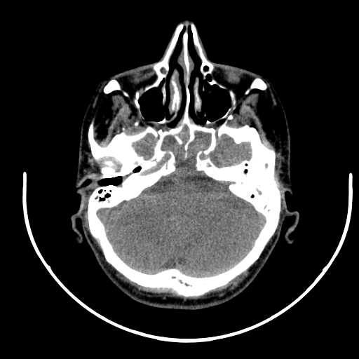 Nasopharyngeal carcinoma - infiltrating the clivus (Radiopaedia 62583-70875 Axial non-contrast 9).jpg