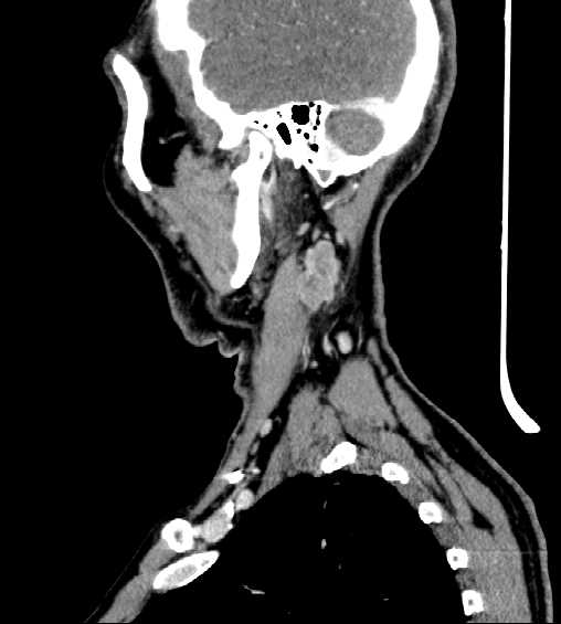File:Nasopharyngeal carcinoma - infiltrating the clivus (Radiopaedia 62583-70875 C 10).jpg