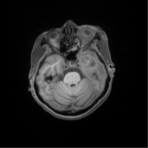 File:Nasopharyngeal carcinoma with cerebral abscess (Radiopaedia 43018-46274 Axial T1 fat sat 18).png