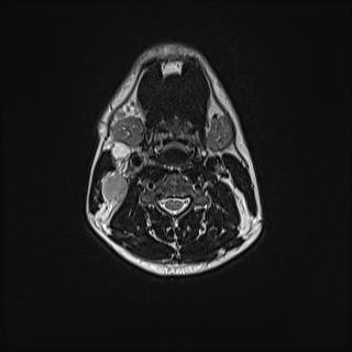 File:Nasopharyngeal carcinoma with perineural spread (Radiopaedia 55030-61380 Axial T2 53).jpg