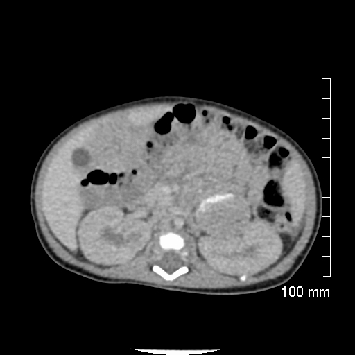 File:Neonatal neuroblastoma (Radiopaedia 56651-63438 Axial non-contrast 36).jpg