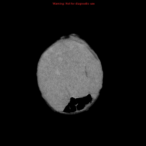 File:Neonatal neuroblastoma (Radiopaedia 9564-10223 B 19).jpg