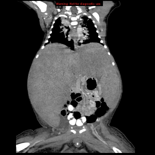 File:Neonatal neuroblastoma (Radiopaedia 9564-10223 B 72).jpg