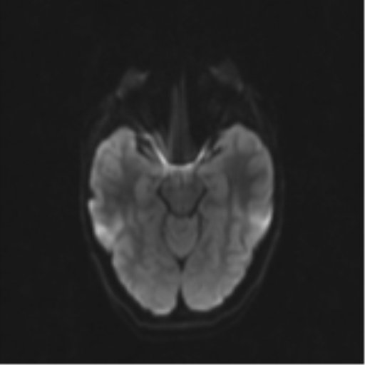Neurenteric cyst (Radiopaedia 58641-65837 Axial DWI 49).png