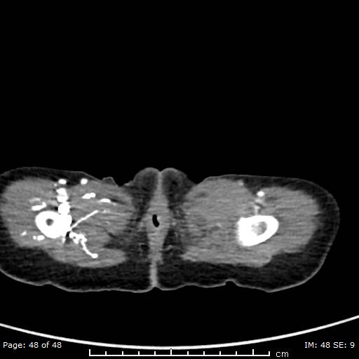 File:Neuroblastoma (Radiopaedia 41472-44355 A 48).jpg