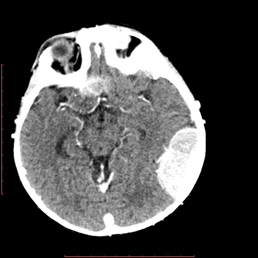 File:Neuroblastoma skull metastasis (Radiopaedia 56053-62683 Axial +Contrast 8).jpg