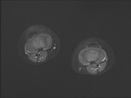 File:Neuroblastoma with bone metastases (Radiopaedia 67080-76414 Axial STIR 4).jpg
