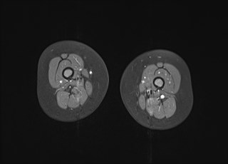 File:Neuroblastoma with bone metastases (Radiopaedia 67080-76414 Axial T1 C+ fat sat 23).jpg