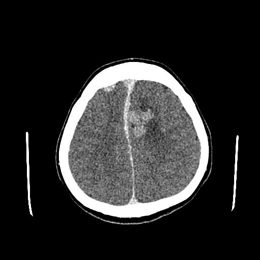 File:Neurofibromatosis type 2 (Radiopaedia 25389-25637 Axial C+ 75).jpg