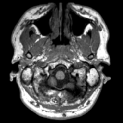 File:Neurofibromatosis type 2 (Radiopaedia 44936-48838 Axial T1 5).png