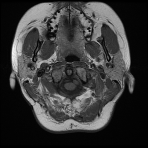 File:Neurofibromatosis type 2 (Radiopaedia 45229-49251 Axial T1 3).png