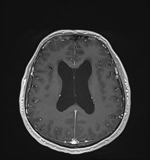 Neurofibromatosis type 2 (Radiopaedia 79097-92049 Axial T1 C+ 123).jpg