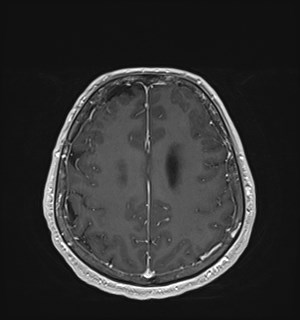 Neurofibromatosis type 2 (Radiopaedia 79097-92049 Axial T1 C+ 145).jpg