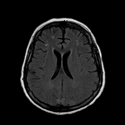 File:Neurofibromatosis type 2 (Radiopaedia 8713-9518 Axial FLAIR 10).jpg