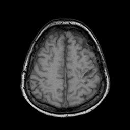 File:Neurofibromatosis type 2 (Radiopaedia 8713-9518 Axial T1 6).jpg