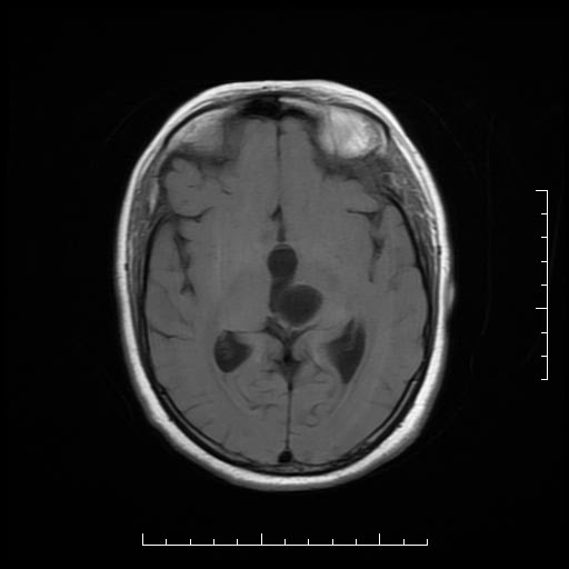 File:Neuroglial cyst of brainstem (Radiopaedia 29134-29526 Axial T1 10).jpg