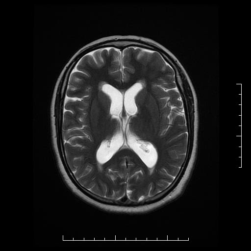 File:Neuroglial cyst of brainstem (Radiopaedia 29134-29526 Axial T2 12).jpg