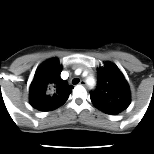 File:Non-small cell lung cancer with miliary metastases (Radiopaedia 23995-24193 A 14).jpg