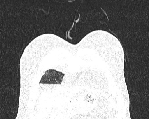 Non-specific interstitial pneumonia (NSIP) (Radiopaedia 68599-78228 Coronal lung window 1).jpg