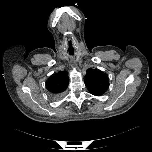 File:Non Hodgkin lymphoma in a patient with ankylosing spondylitis (Radiopaedia 84323-99624 Axial non-contrast 6).jpg