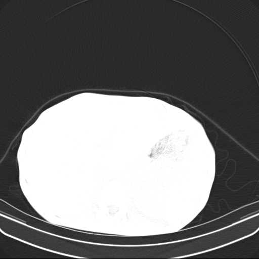File:Non hodgkin lymphoma of the mediastinum (Radiopaedia 20814-20729 Axial lung window 57).jpg