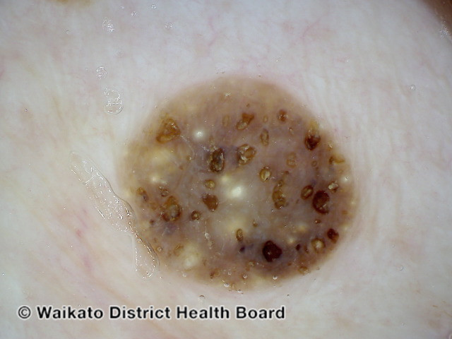 File:Nonpolarised dermoscopy of seborrhoeic keratosis (DermNet NZ nonpolarised-sebk).jpg