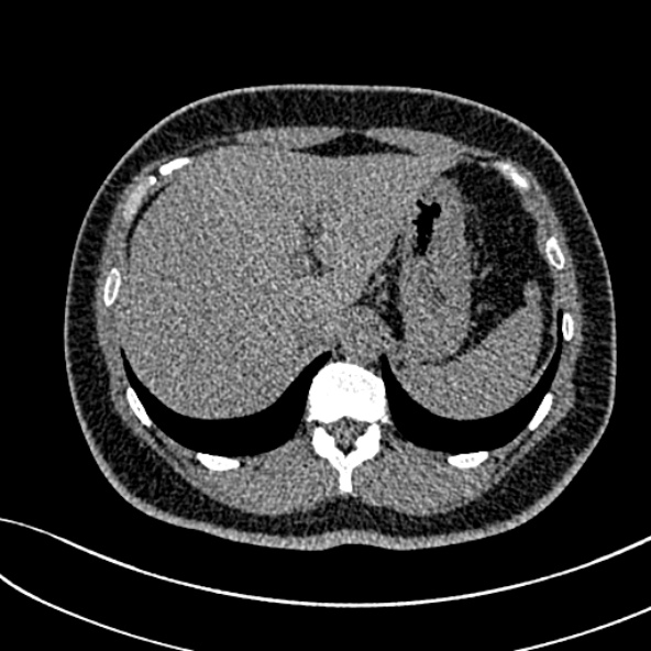 Normal CT chest- adult female (Radiopaedia 52522-58428 Axial non-contrast 121).jpg