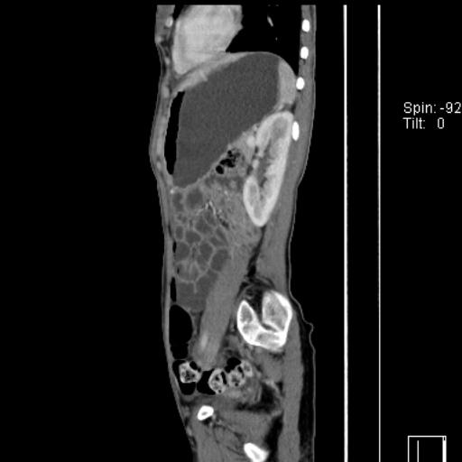 Normal CT enterography (Radiopaedia 30357-31000 D 15).jpg