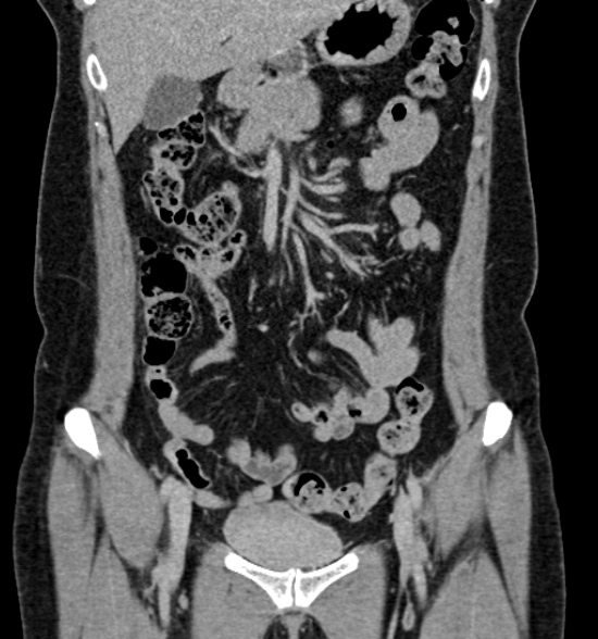 Normal CT intravenous urogram (Radiopaedia 39444-41759 A 221).jpg