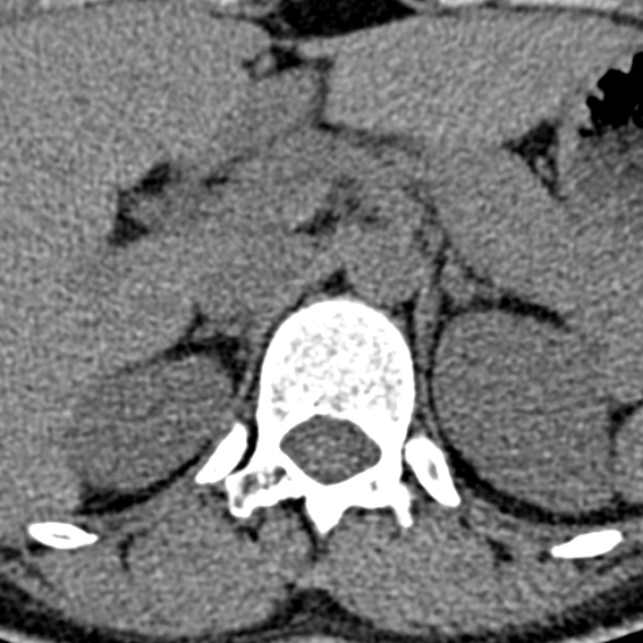Normal CT lumbar spine (Radiopaedia 53981-60118 Axial non-contrast 5).jpg