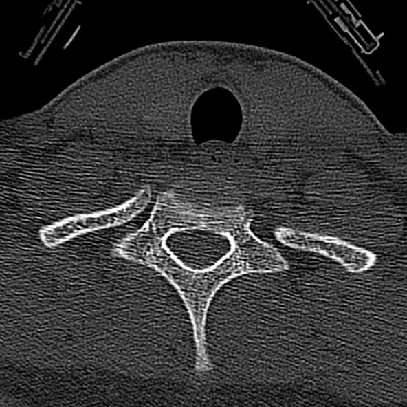 Normal CT of the cervical spine (Radiopaedia 53322-59305 Axial bone window 227).jpg