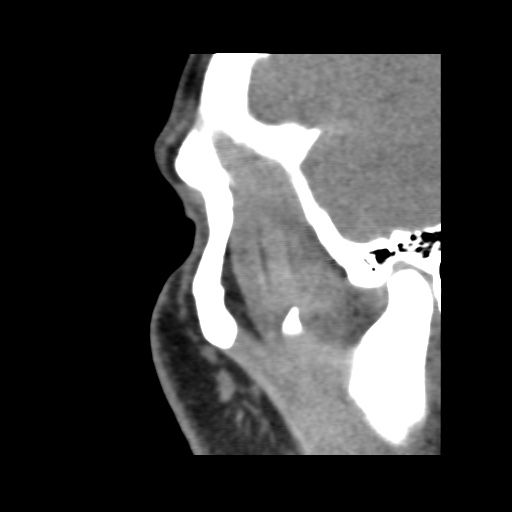 Normal CT paranasal sinuses (Radiopaedia 42286-45390 F 125).jpg